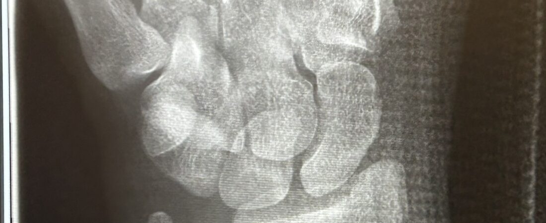 A broken wrist and a broken heart