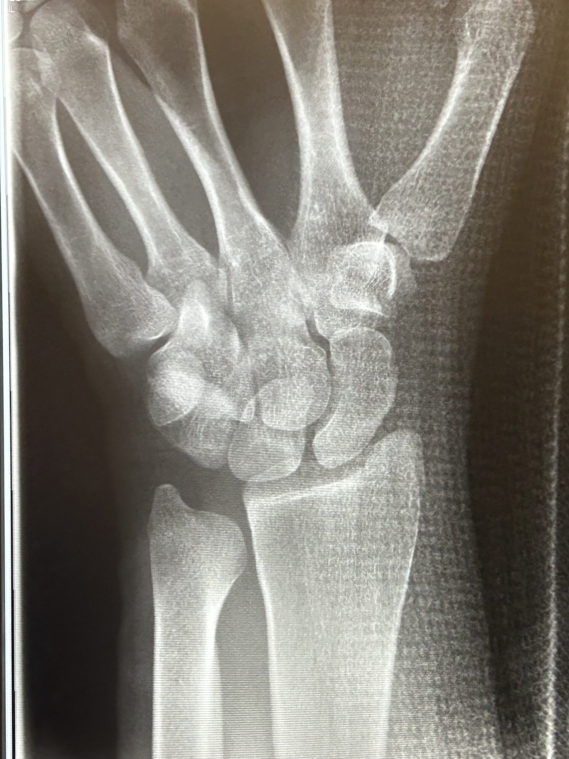 A broken wrist and a broken heart